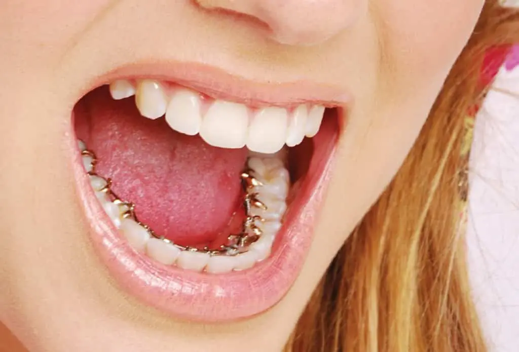 Aparelho lingual: dentes alinhados com discrição