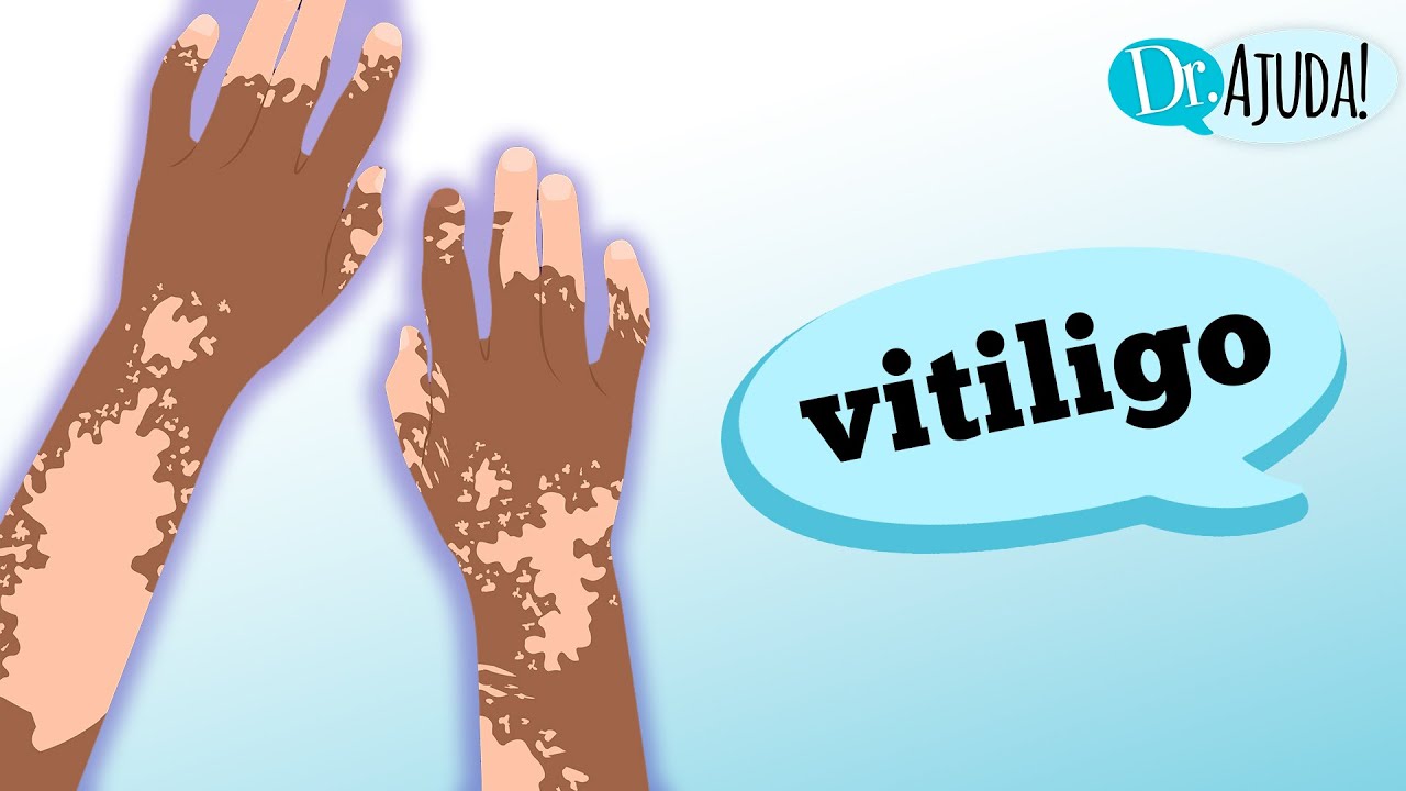 Vitiligo e as MANCHAS BRANCAS no corpo: o que é?