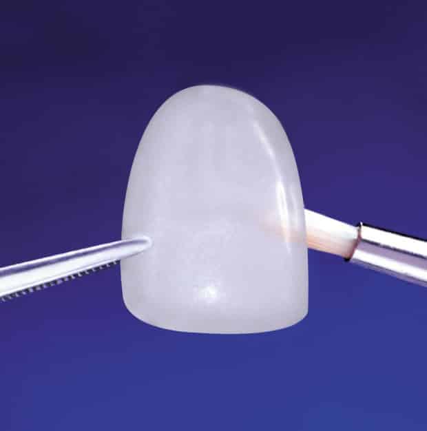 Lente de contato dental: sorriso bonito e alinhado 2 Lente de contato dental: sorriso bonito e alinhado