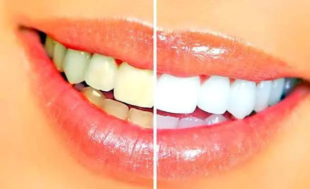 Lente de contato dental: sorriso bonito e alinhado