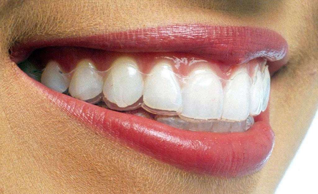 Beleza/Saúde: Aparelho invisível é a mais nova opção para alinhar dentes 1 Beleza/Saúde: Aparelho invisível é a mais nova opção para alinhar dentes