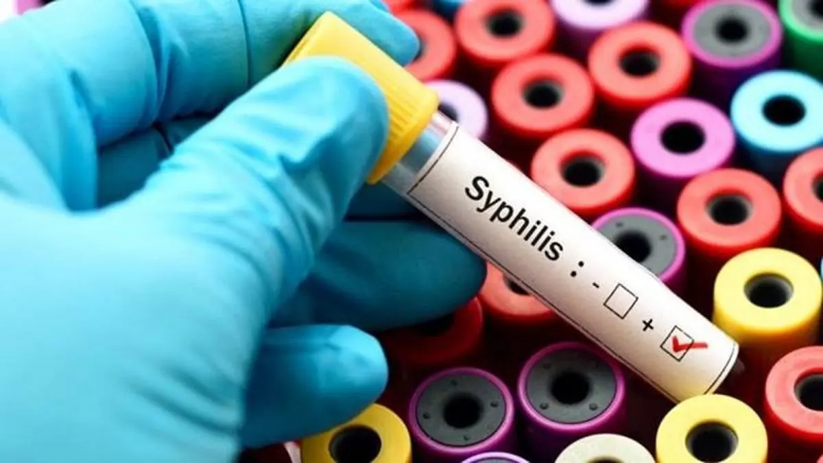 Saúde divulga boletim sobre sífilis em Santa Catarina