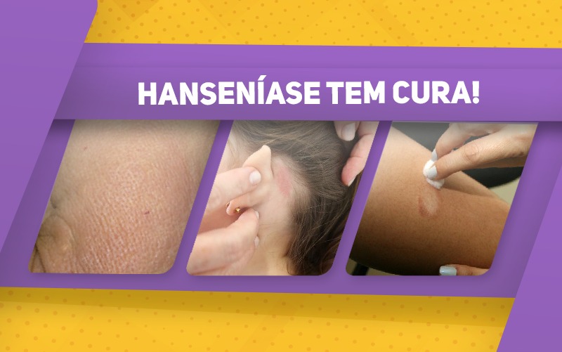 A importância do diagnóstico precoce da hanseníase