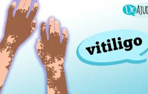 Vitiligo: o que é vitiligo e quando suspeitar