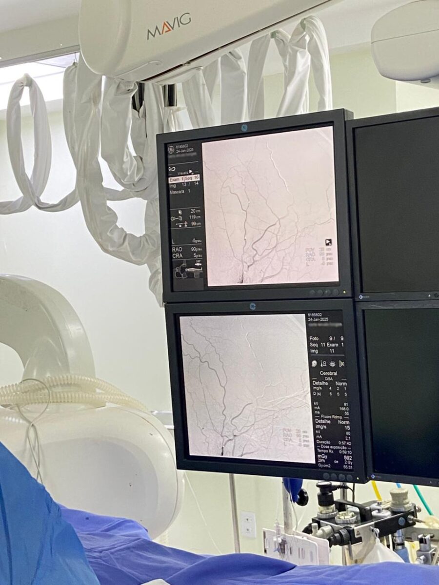HSJosé: tratamento inovador para doenças cerebrovasculares é realizado pela primeira vez em Santa Catarina