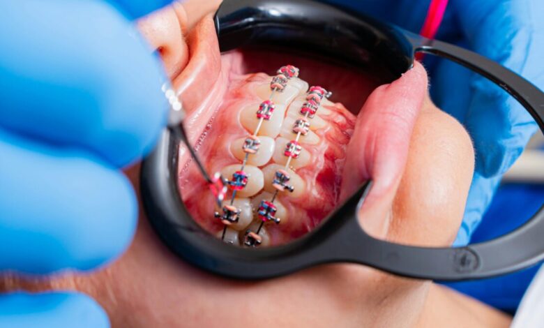 Por que os dentes voltam a entortar após o uso de aparelho ortodôntico