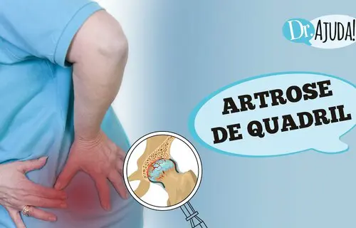 Artrose de quadril: Quando suspeitar? Como tratar?