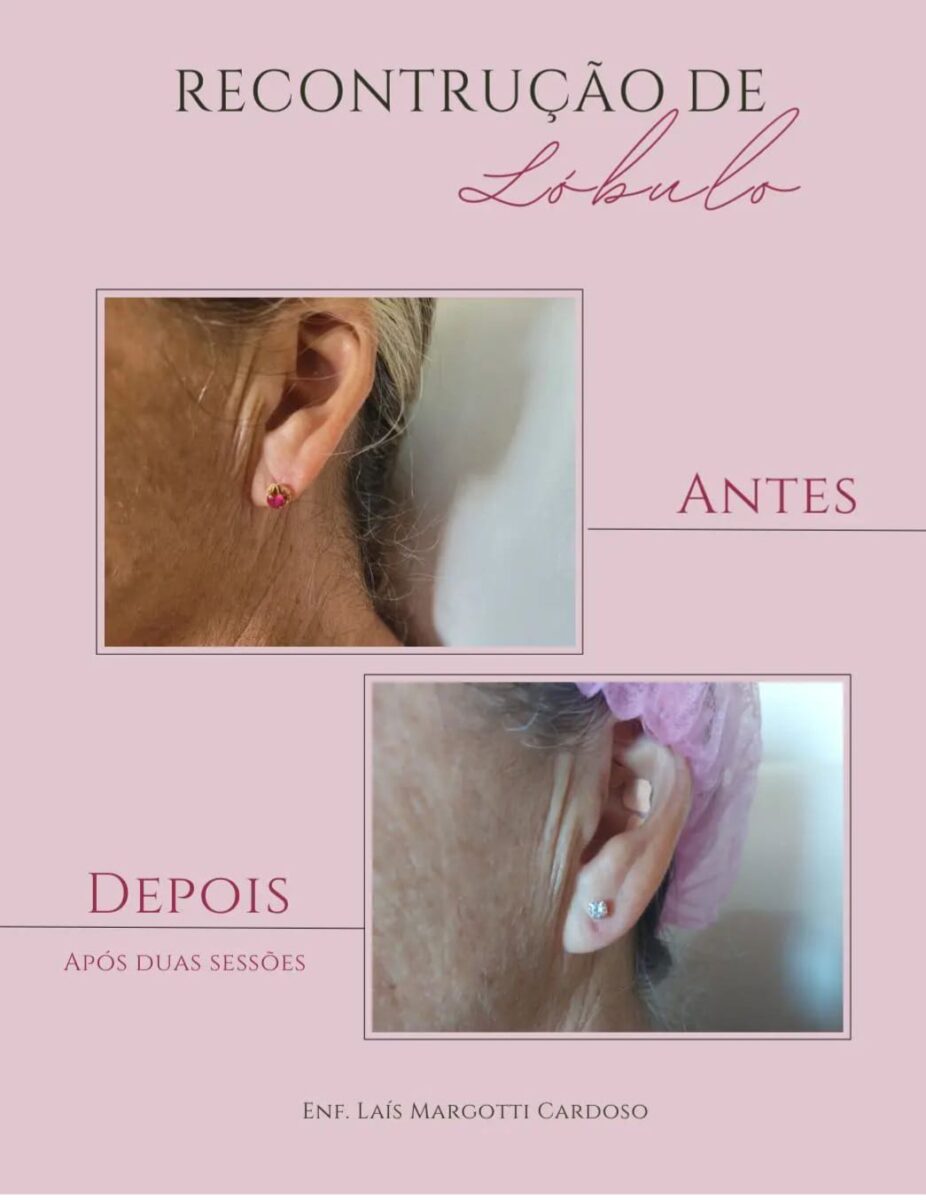 A arte da perfuração auricular sem traumas com Laís Margotti Cardoso 4 A arte da perfuração auricular sem traumas com Laís Margotti Cardoso